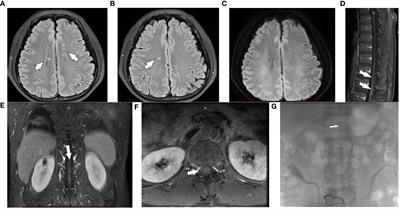 Autoimmune glial fibrillary acidic protein astrocytopathy complicated with low flow perimedullary arteriovenous fistula: a case report